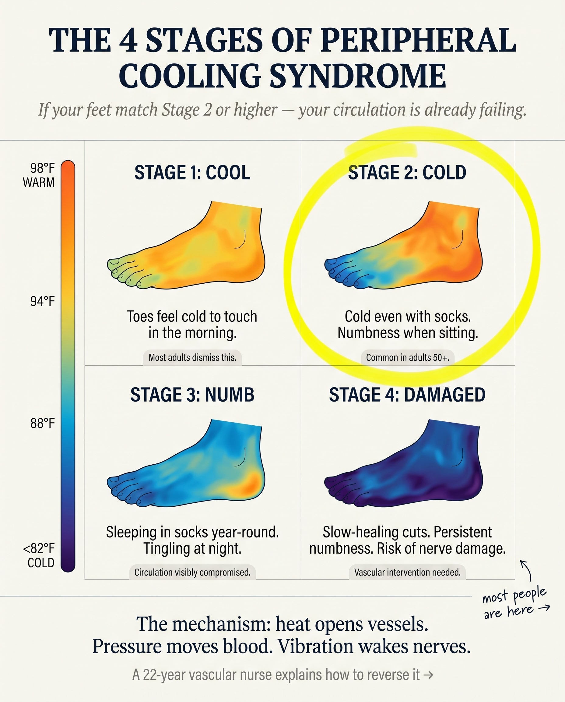 Anatomical diagram of the four stages of Peripheral Cooling Syndrome showing cool, cold, numb, and damaged feet