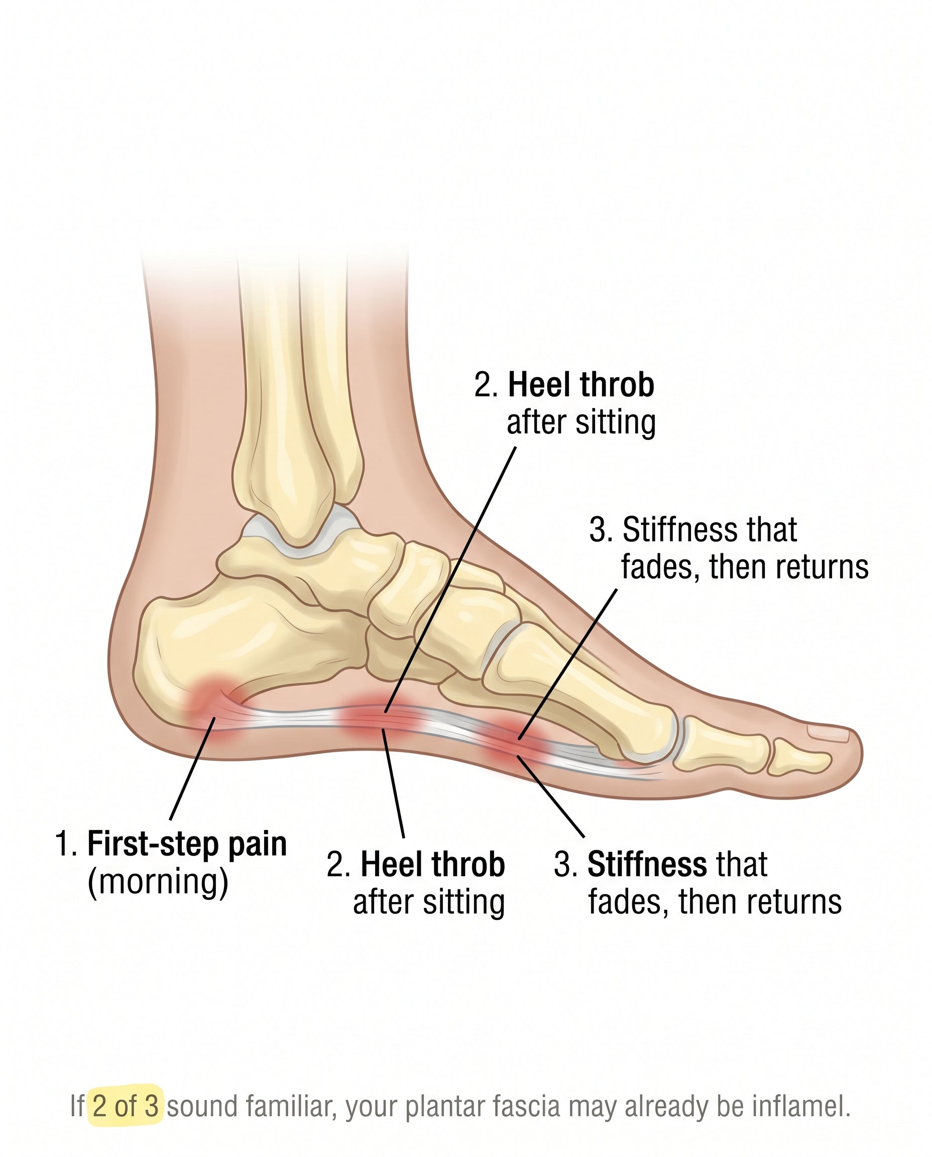 Anatomical cross-section of a human foot showing the plantar fascia with three inflammation zones labeled for the three early signs of plantar fasciitis