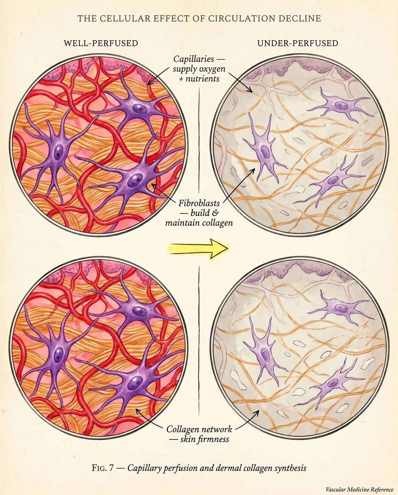 Two-panel medical illustration comparing well-perfused dermal tissue with abundant capillaries and healthy fibroblasts versus under-perfused tissue with sparse capillaries, shrunken fibroblasts, and broken collagen fibers